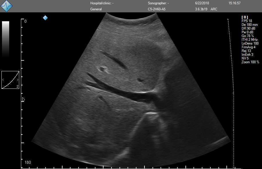 Abdomen ultrasound image