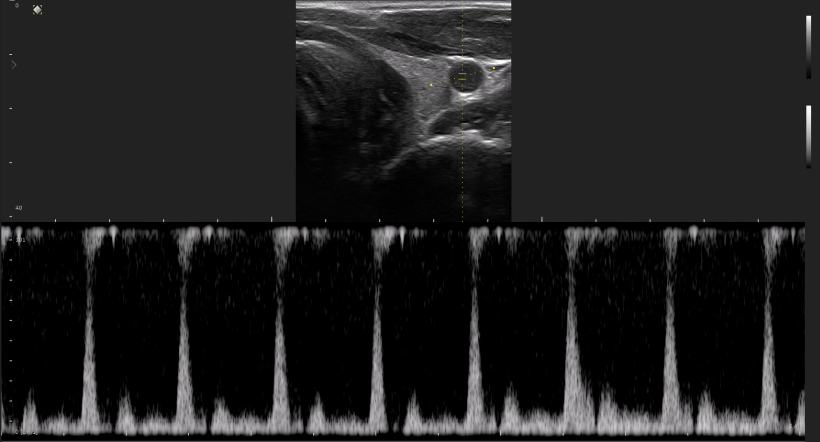 MicrUs Carotid
