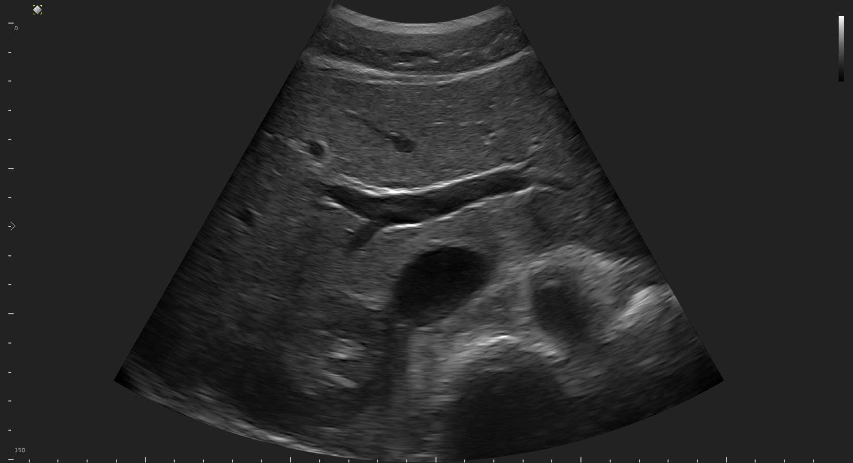 Micrus Pro Abdomen Ultrasound Image