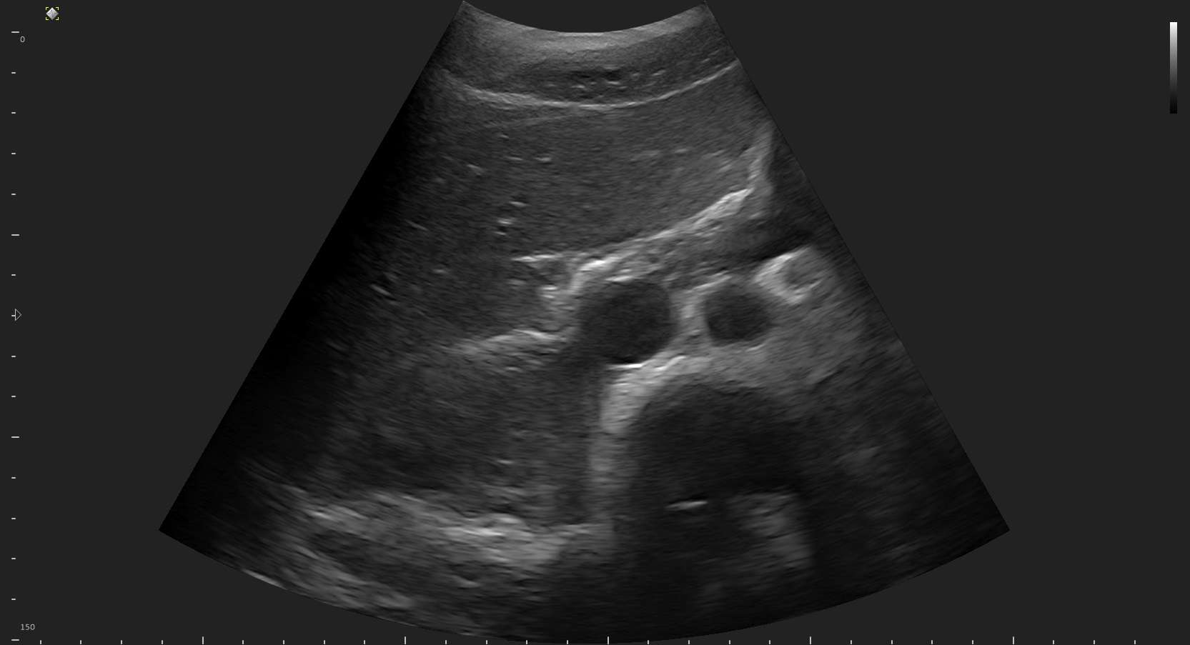 Abdomen Ultrasound MicruS pro