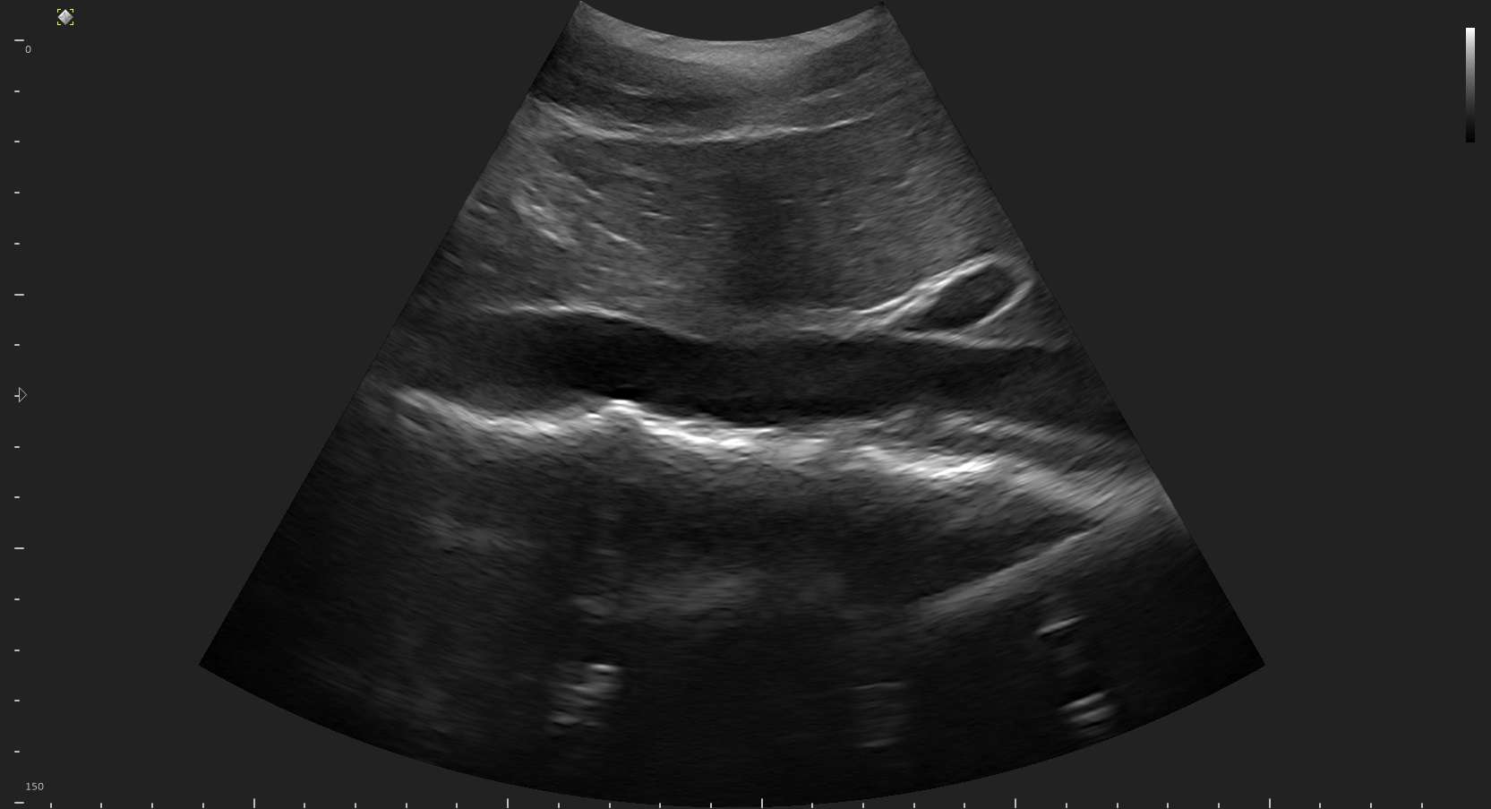  ultrasound image using MicrUs Pro